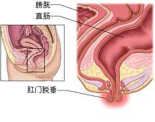 肛门坠胀