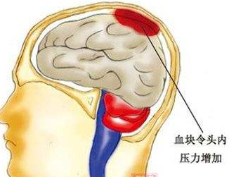 脑干出血