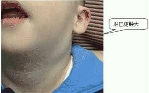 淋巴结肿大
