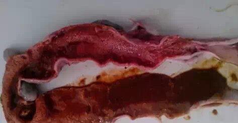 肠出血