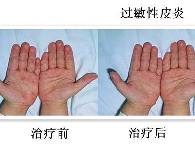 过敏性皮炎
