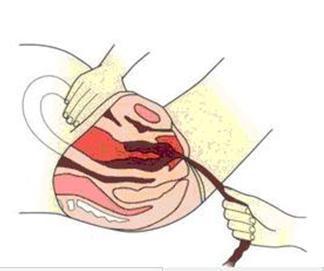 产后出血