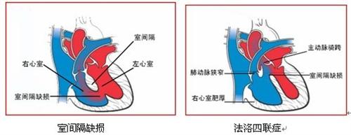 右心衰竭