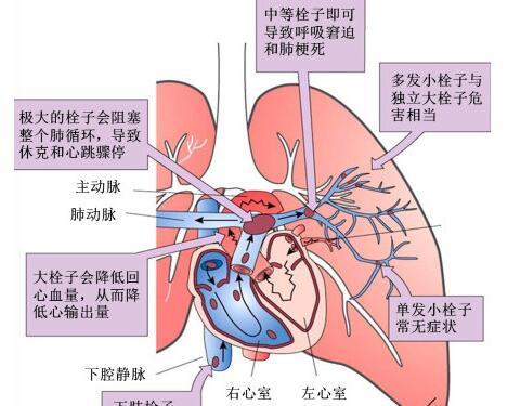 右心衰竭