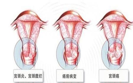 急性宫颈炎