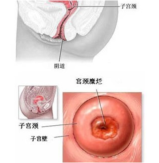 急性宫颈炎