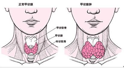甲状腺肿