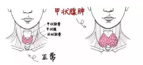 甲状腺肿
