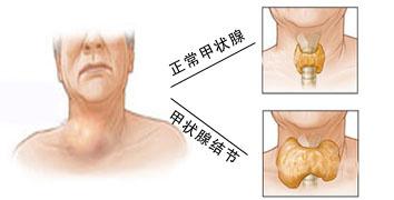 甲状腺肿