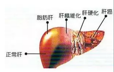 肝纤维化