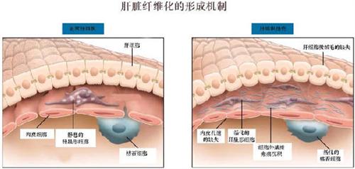 肝纤维化