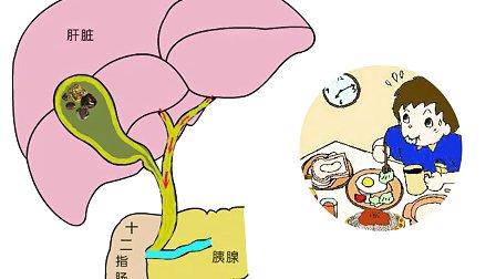 胆总管结石