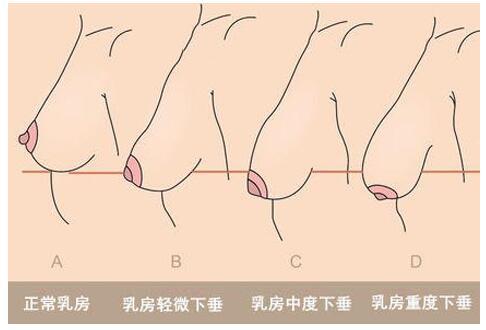 胸部下垂