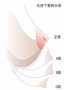 胸部下垂