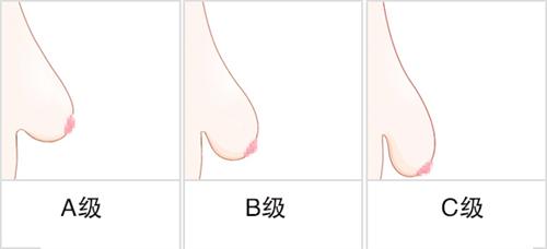 胸部下垂
