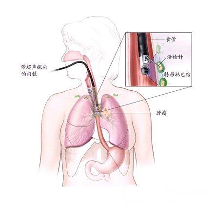 胸骨后疼痛