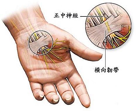 腕管综合征