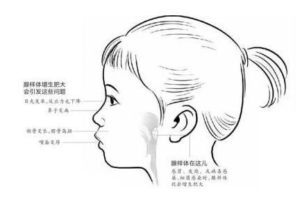 腺样体面容