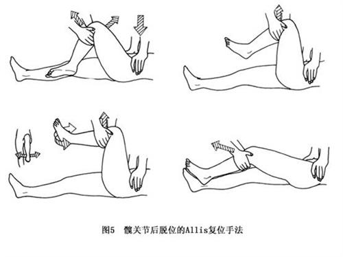 髋关节脱位