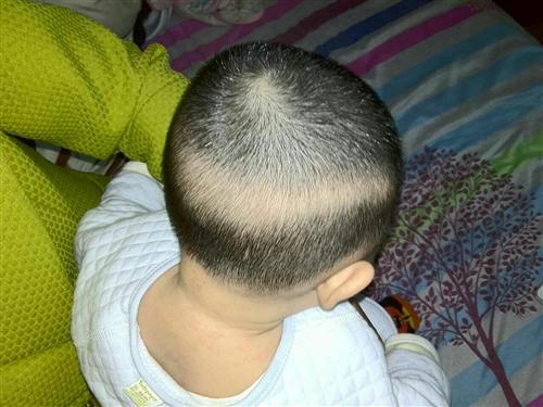 婴儿枕秃