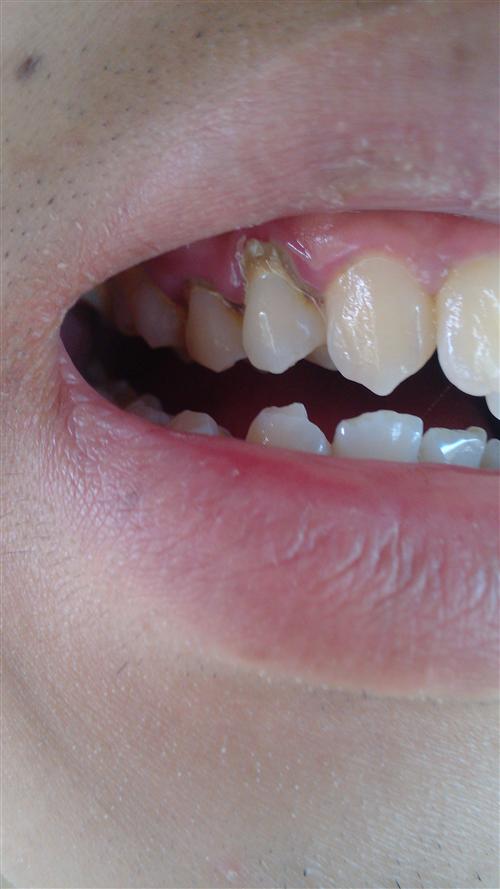 发病部位:并发疾病热门问答孩子牙齿发黄有白斑怎么回事牙齿发黄牙龈