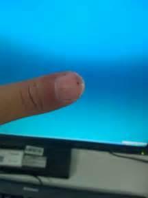 甲下出血