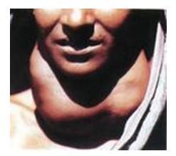 甲状腺肿
