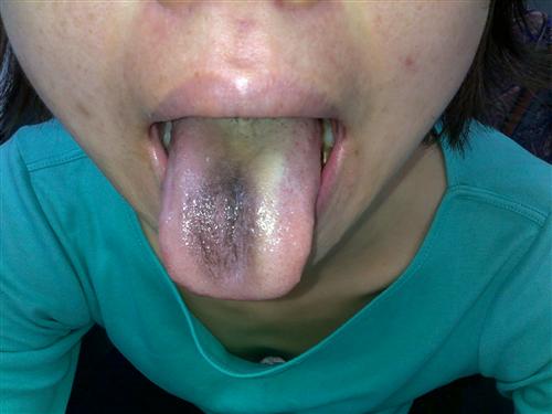 舌苔厚腻