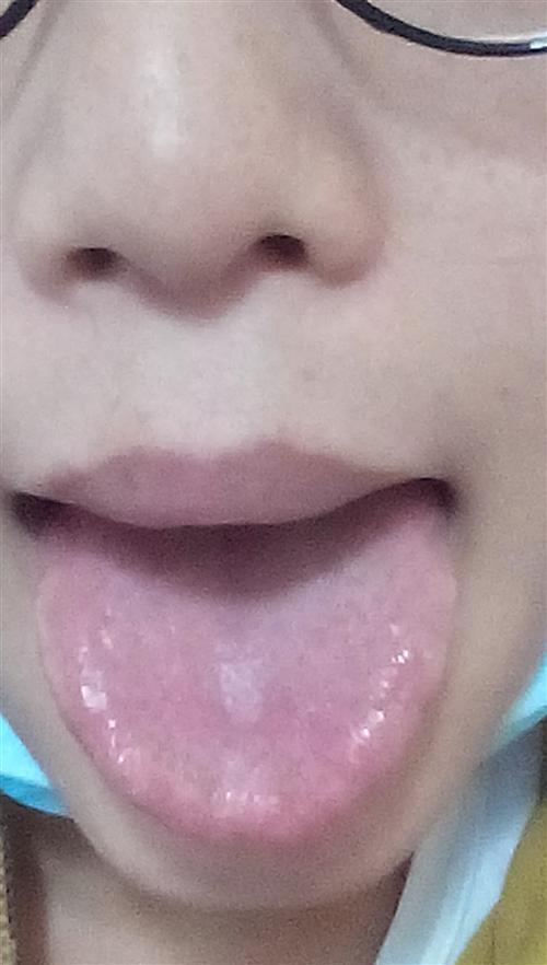 舌苔厚