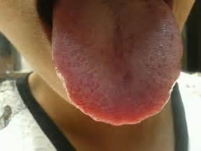 舌苔厚