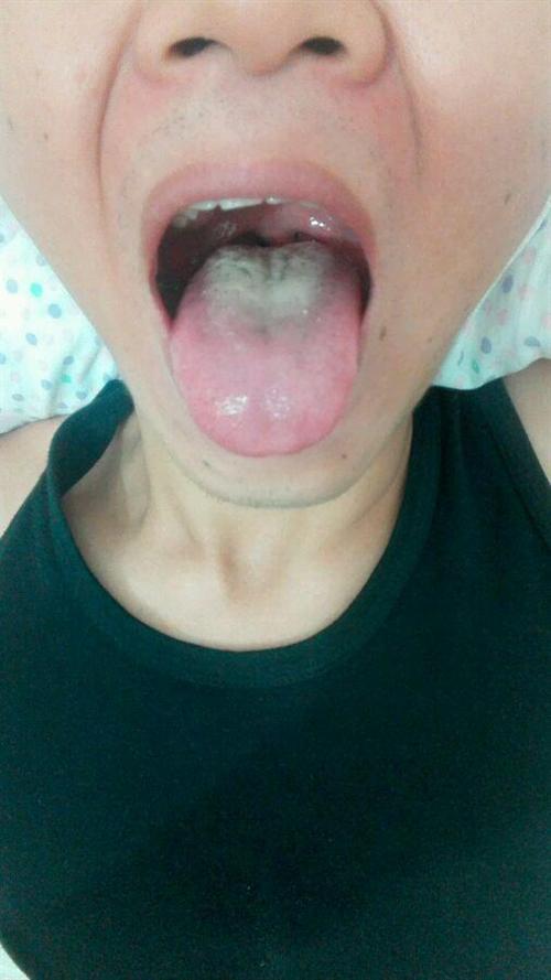 舌苔薄白