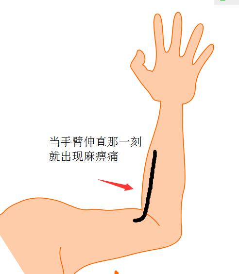 右手臂酸痛