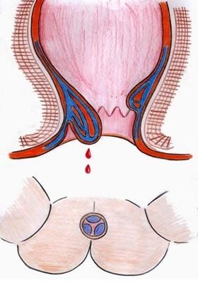肛门出血