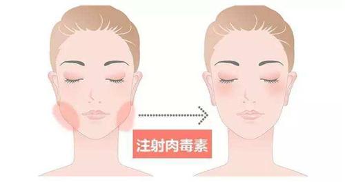咬肌肥大