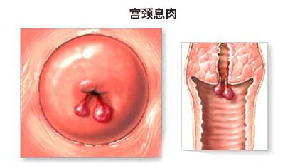 宫颈举痛