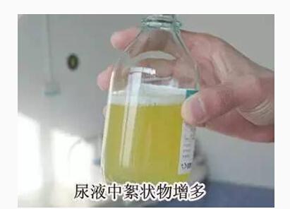 尿液混浊