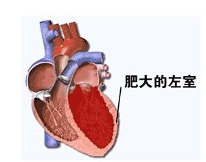 左心室肥厚