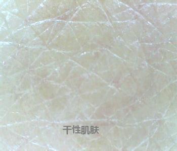 干性皮肤