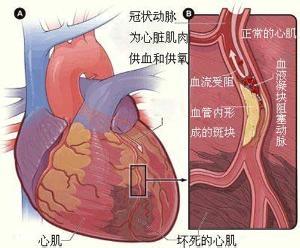 心室肥大