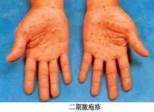 梅毒感染