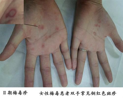 梅毒感染