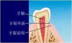 牙根外露