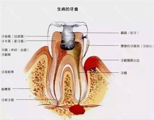 牙根外露
