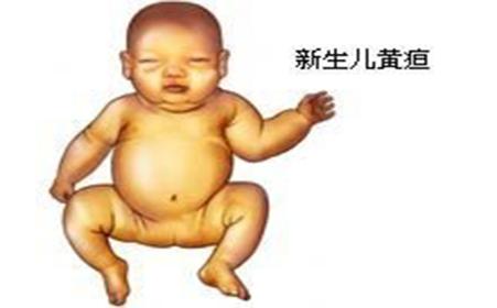 生理性黄疸