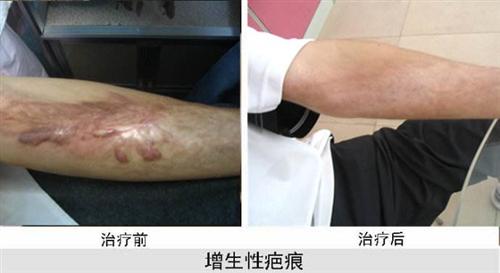 疤痕增生