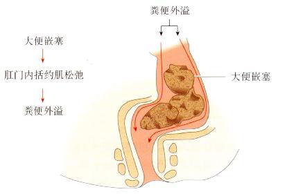 痉挛性便秘