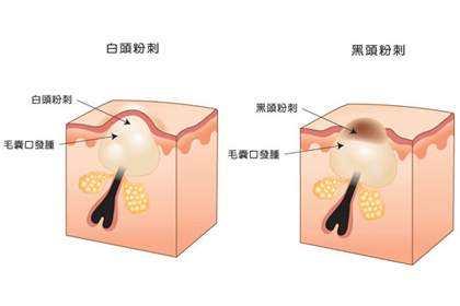 白头粉刺