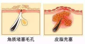白头粉刺