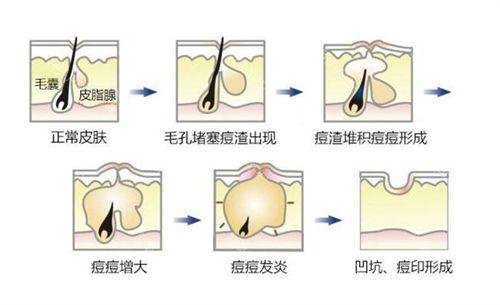 怎么去白头粉刺