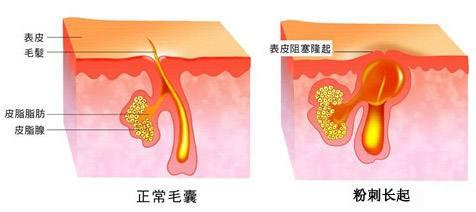 白头粉刺